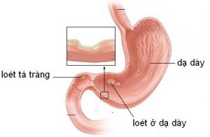 ung thư dạ dày