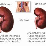 bệnh thận