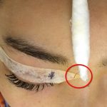 Phẩu thuật tạo hình mí mắt