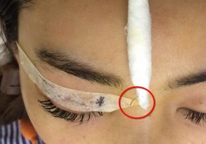 Phẩu thuật tạo hình mí mắt